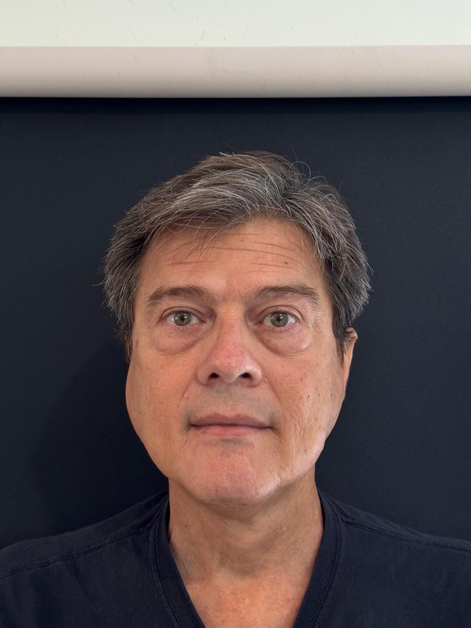 Después blefaroplastia caso 3